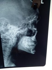 Phẫu thuật thành công số lượng lớn Nep+Vít vùng hàm mặt tại khoa Răng Hàm Mặt Bệnh Viện Đa Khoa Sơn Tây Hà Nội.