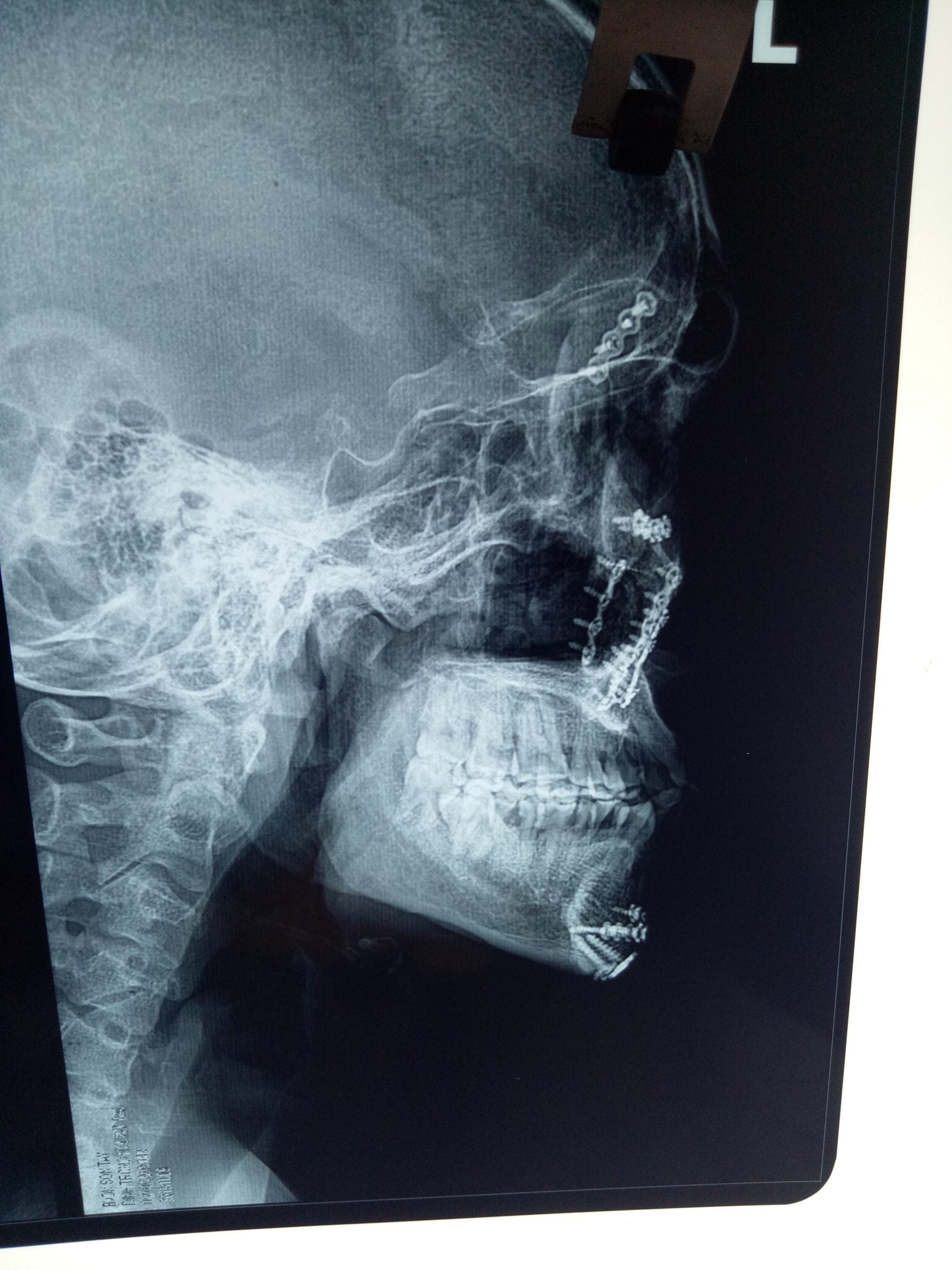 Phẫu thuật thành công số lượng lớn Nep+Vít vùng hàm mặt tại khoa Răng Hàm Mặt Bệnh Viện Đa Khoa Sơn Tây Hà Nội.