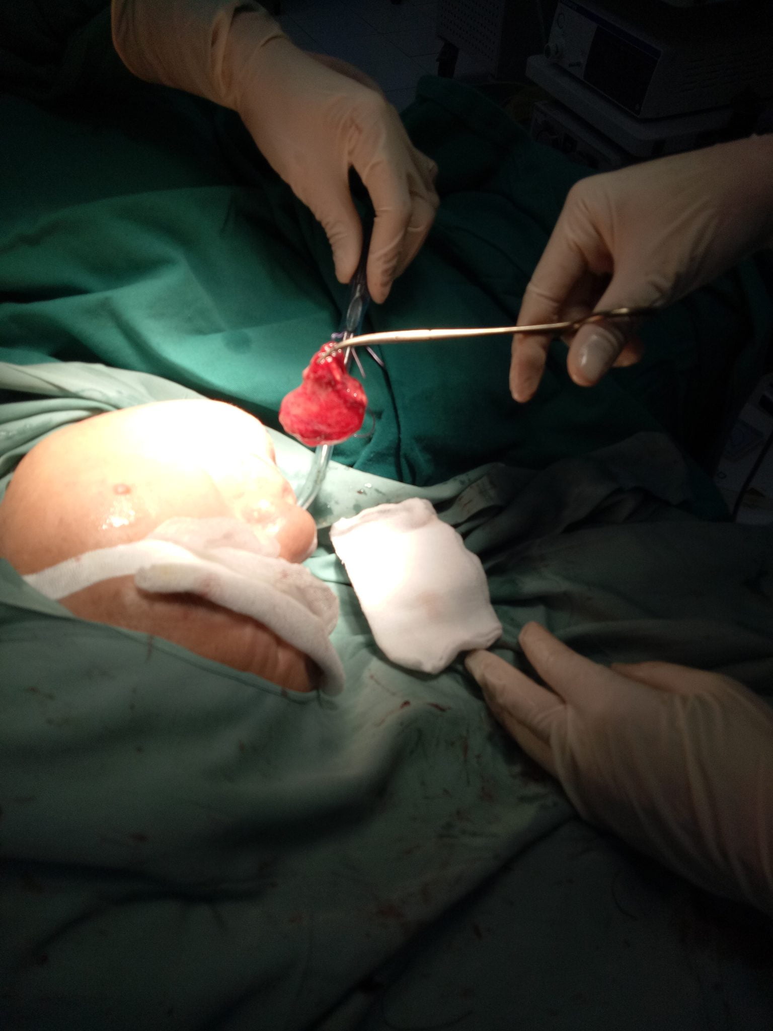 Cải thiện cuộc sống sau phẫu thuật u lớn sàn miệng