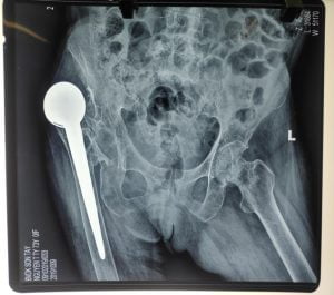 Nhân trường hợp trật khớp háng viêm dò kéo dài.