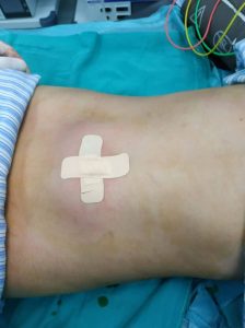 MỔ RUỘT THỪA VIÊM CHỈ VỚI… 01 LỖ Ở RỐN