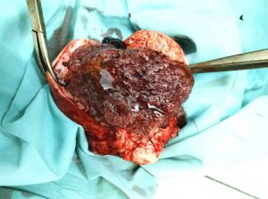 PHẪU THUẬT BẢO TỒN 2 PHẦN PHỤ CỦA TỬ CUNG CHO BỆNH NHÂN CHỬA TRỨNG