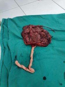 KHOA SẢN BỆNH VIỆN ĐA KHOA SƠN TÂY VỪA XỬ LÝ MỘT CA MỔ ĐẺ HIẾM GẶP: DÂY RỐN BÁM MÀNG