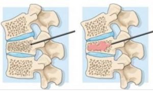 Bệnh viện đa khoa Sơn Tây chữa trị xẹp thân đốt sống, chỉnh gù cột sống, và giải ép tủy cho bệnh nhân xẹp thân đốt sống lâu năm, biến dạng cột sống.