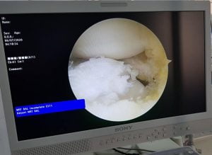 BỆNH VIỆN ĐA KHOA SƠN TÂY PHẪU THUẬT NỘI SOI CẮT SỤN CHÊM HÌNH ĐĨA – THỂ BẤT THƯỜNG, HIẾM GẶP