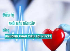 BỆNH VIỆN ĐA KHOA SƠN TÂY ĐIỀU TRỊ ĐỘT QUỴ NHỒI MÁU NÃO CẤP BẰNG PHƯƠNG PHÁP TIÊU SỢI HUYẾT
