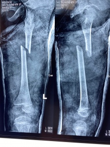 PHẪU THUẬT KẾT HỢP XƯƠNG ĐÙI AN TOÀN, ÍT XÂM LẤN Ở TRẺ EM