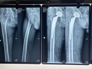 THAY KHỚP HÁNG CHO BỆNH NHÂN 103 TUỔI