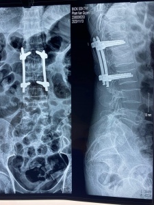 PHẪU THUẬT ÍT XÂM LẤN VỀ CỘT SỐNG ĐƯỢC ÁP DỤNG TẠI BỆNH VIỆN ĐA KHOA SƠN TÂY